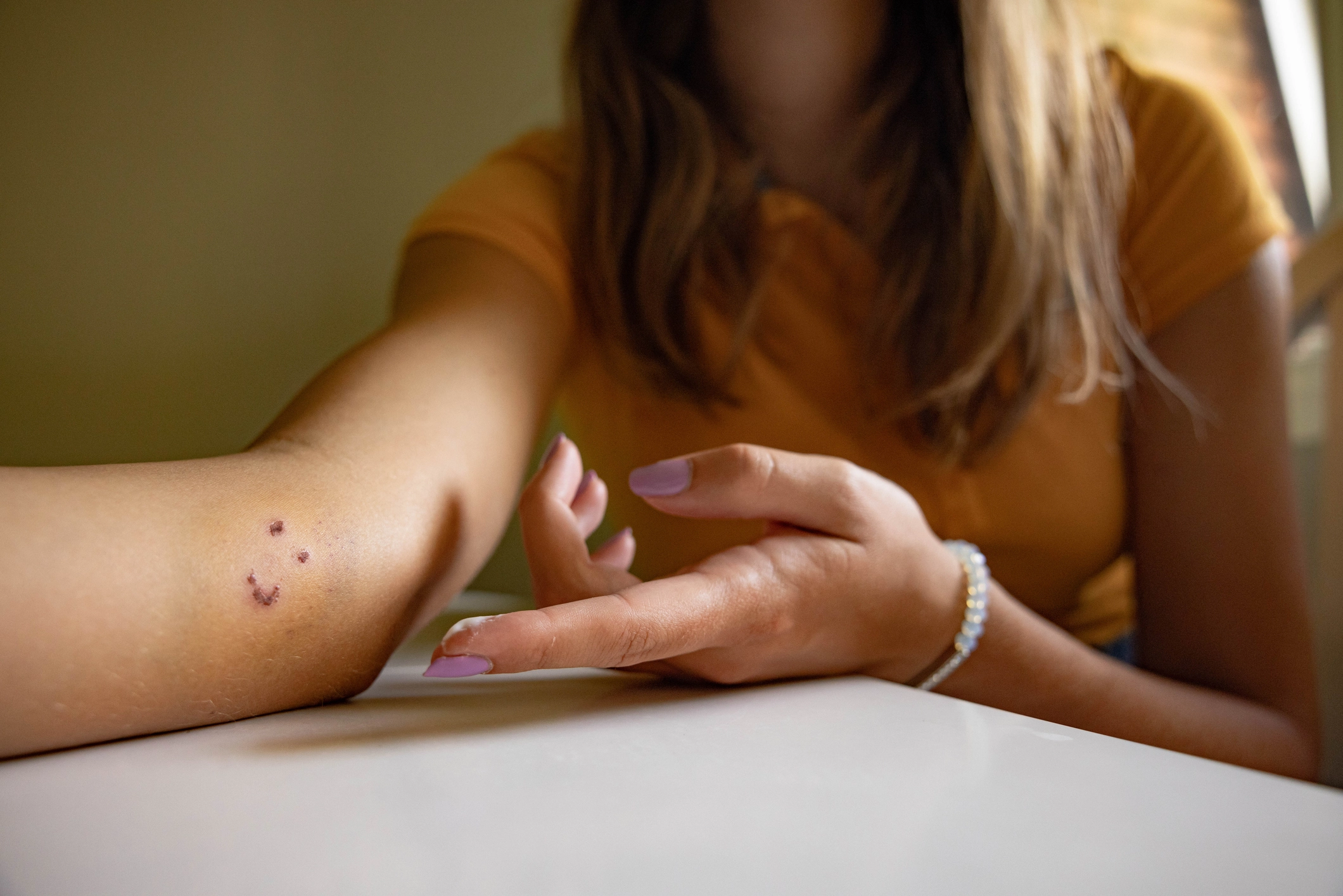 Young woman with a dog bite on her upper limb in a shape of a smiley face
