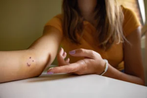Legal Steps to Take After a Dog Bite Incident